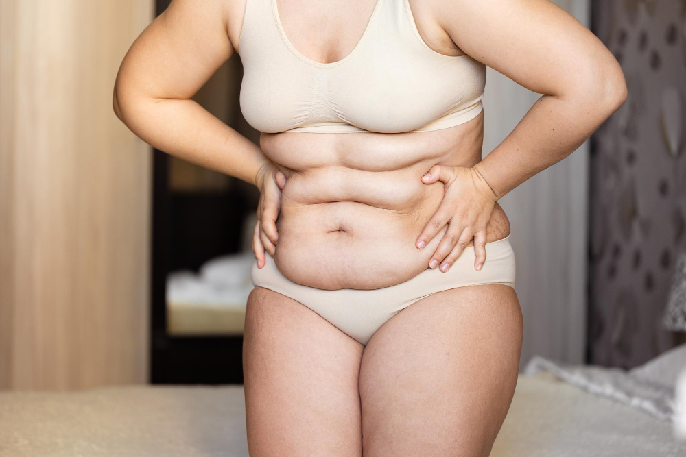 How to Get Rid of Love Handles: Treatments That Work