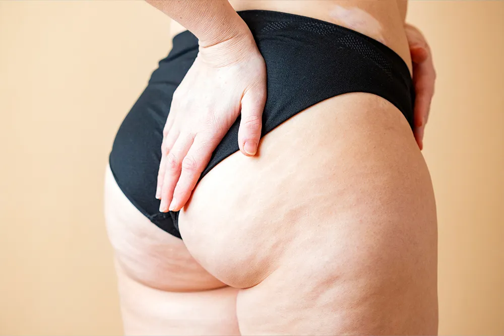 cellulite reduction treatment