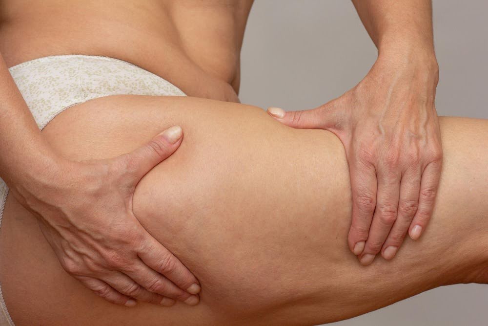 Cellulite Reduction Cost Near Soho
