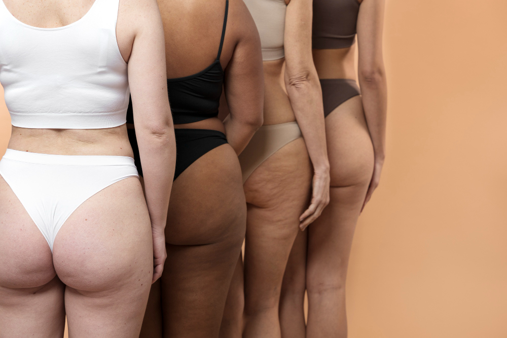 What Causes Cellulite