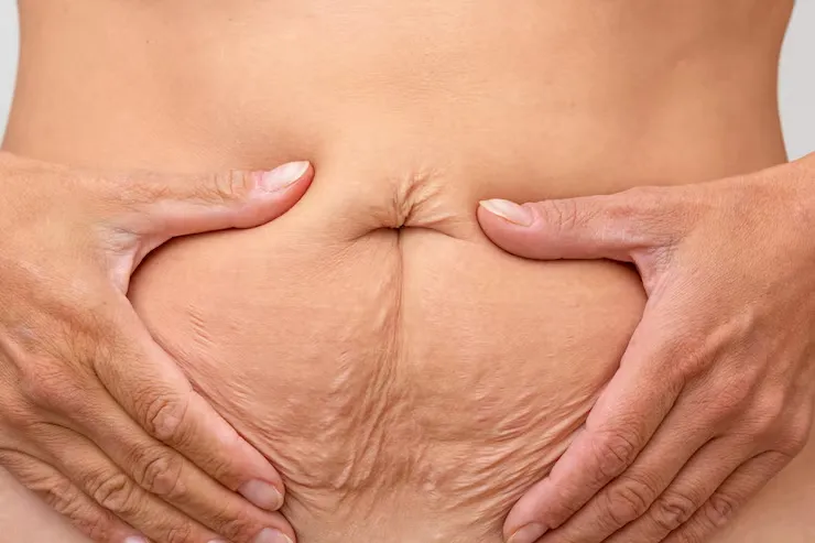 Tighten Loose Skin After Weight Loss