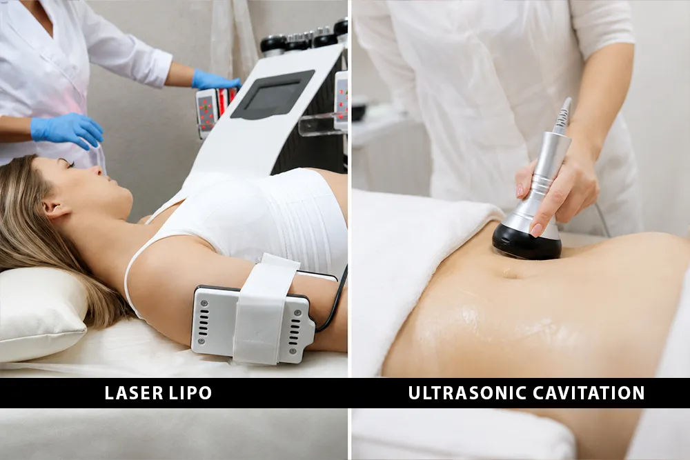 Laser Lipo vs Ultrasonic Cavitation: Can Treatments Be Combined?