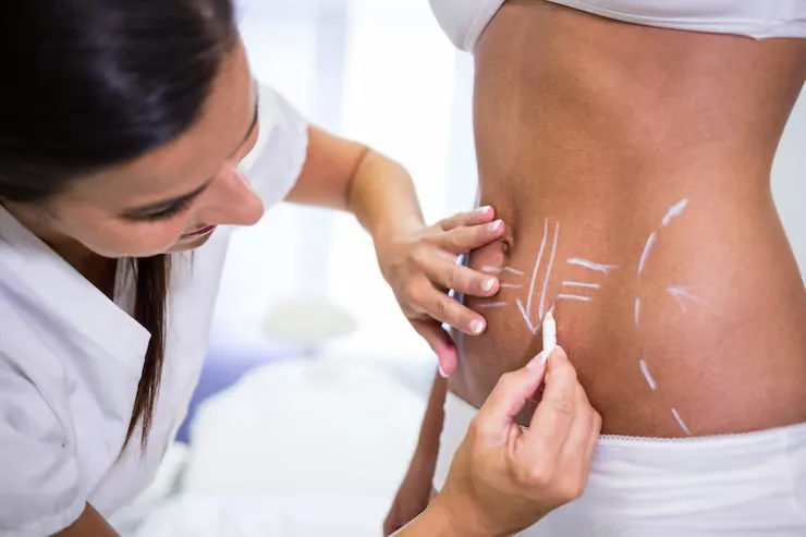 Body Contouring for Love Handles